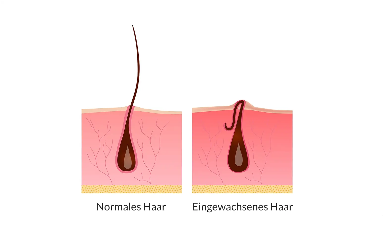 Normales Haar vs Eingewachsenes Haar